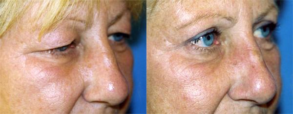 Eyelid Surgery Before & After Gallery - Patient 350270 - Image 2