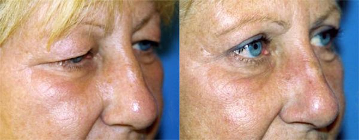 Eyelid Surgery Before & After Gallery - Patient 122405841 - Image 2