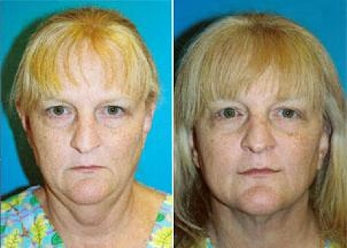 Facelift Before & After Gallery - Patient 122405844 - Image 1