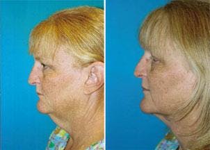 Facelift Before & After Gallery - Patient 122405844 - Image 2
