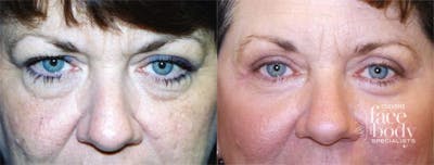 Eyelid Surgery Before & After Gallery - Patient 886786 - Image 1