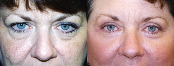 Eyelid Surgery Before & After Gallery - Patient 122405842 - Image 1
