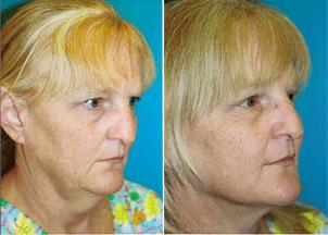 Facelift Before & After Gallery - Patient 122405844 - Image 3