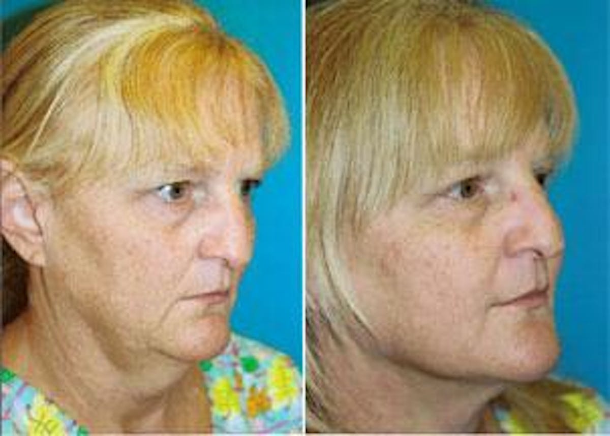 Facelift Before & After Gallery - Patient 122405844 - Image 3