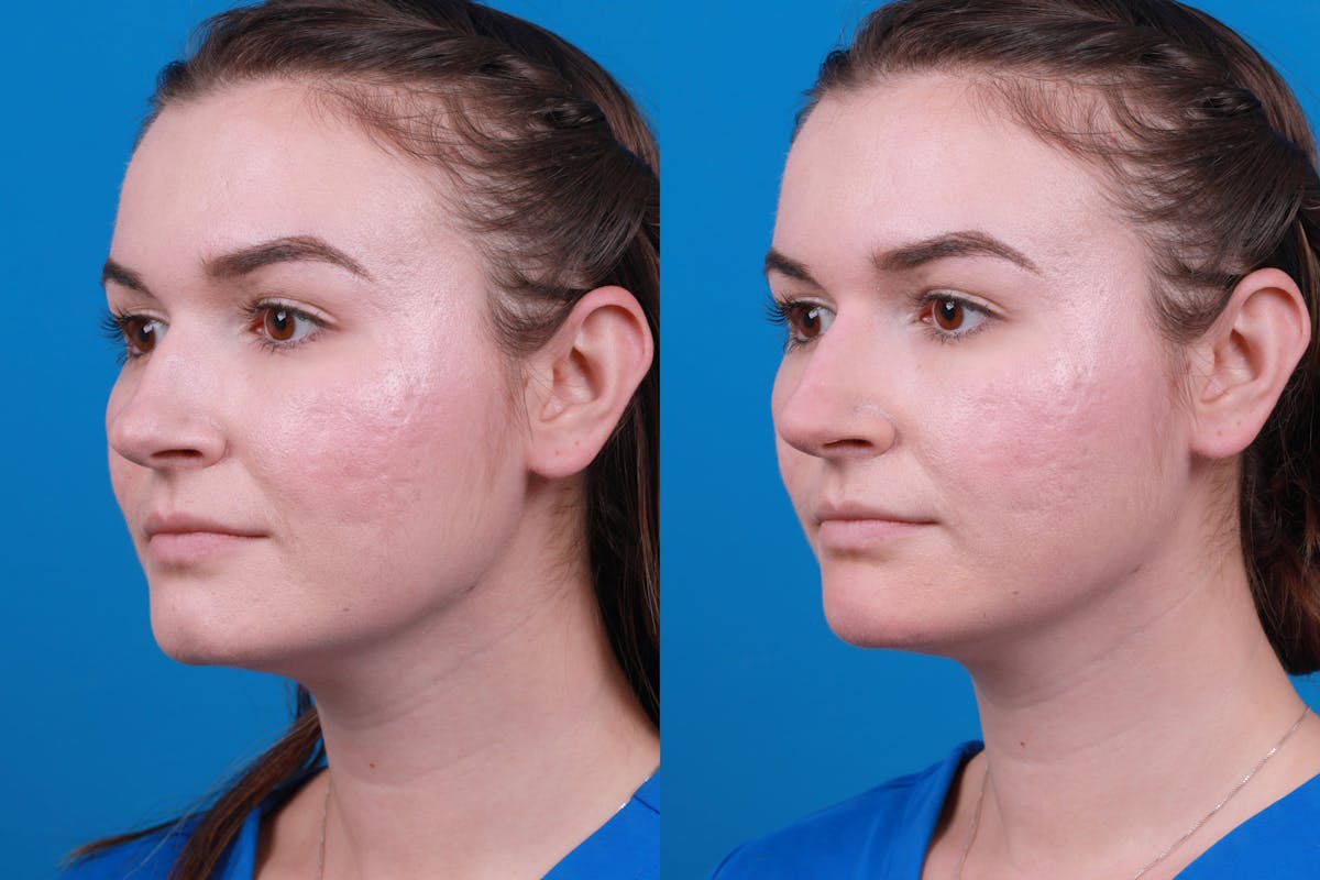 Dermal Fillers Before & After Gallery - Patient 122405853 - Image 2
