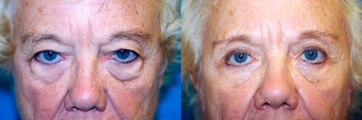 Eyelid Surgery Before & After Gallery - Patient 122405845 - Image 1