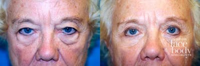 Eyelid Surgery Before & After Gallery - Patient 216610 - Image 1