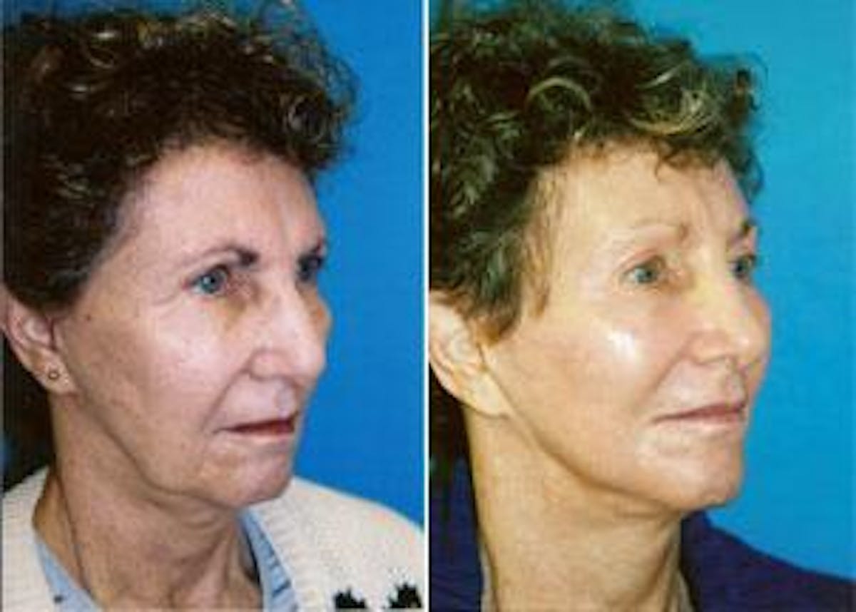 Facelift Before & After Gallery - Patient 122405846 - Image 1