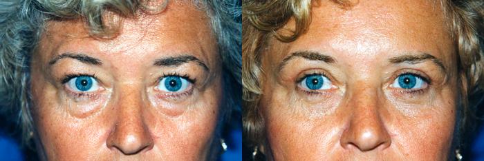 Eyelid Surgery Before & After Gallery - Patient 284078 - Image 1
