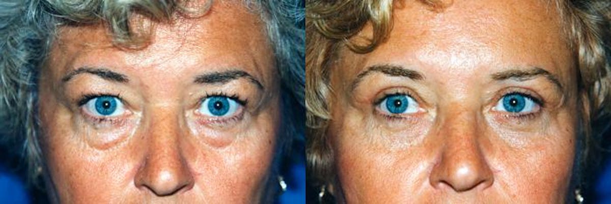 Eyelid Surgery Before & After Gallery - Patient 122405847 - Image 1