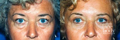 Eyelid Surgery Before & After Gallery - Patient 284078 - Image 1