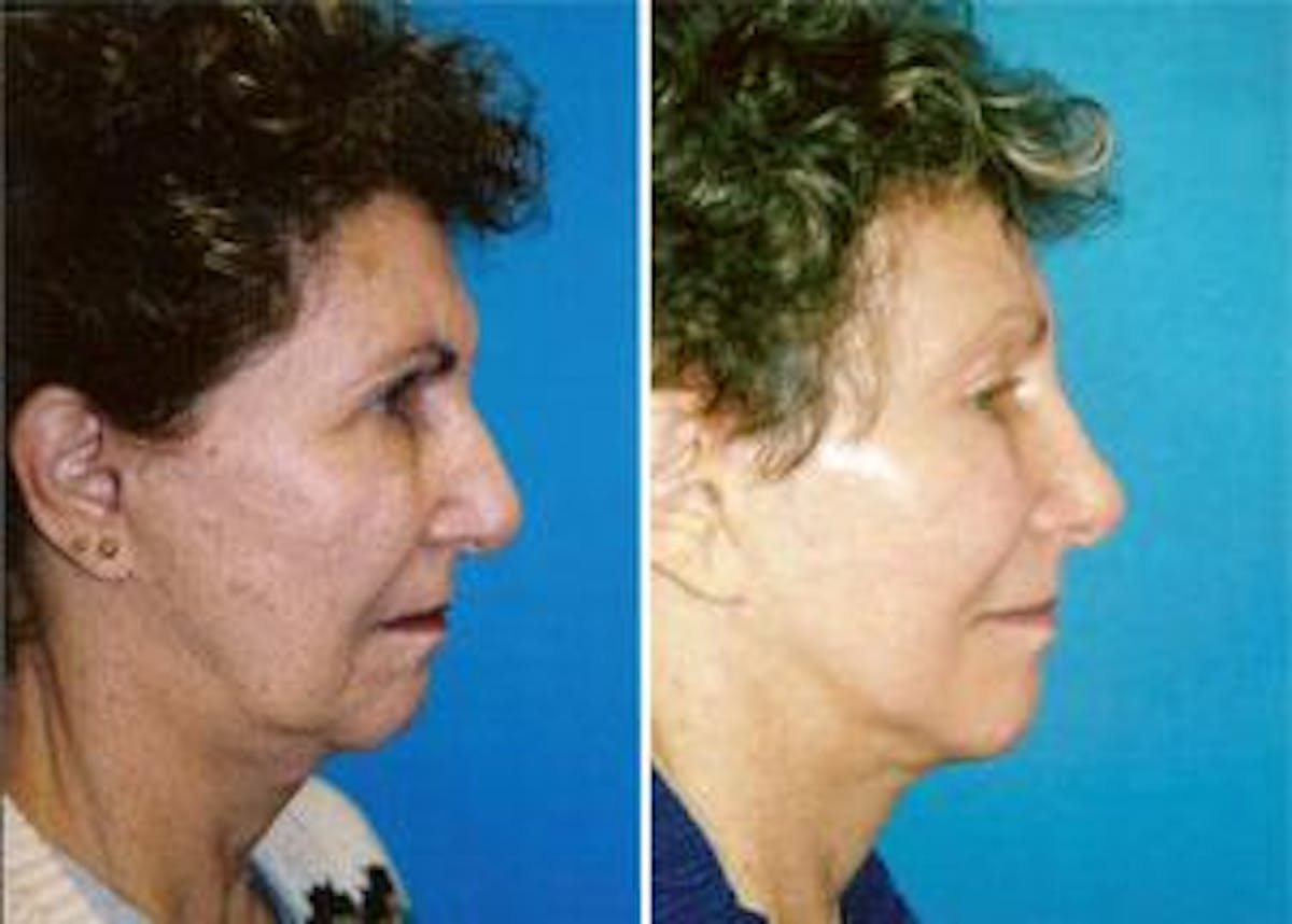 Facelift Before & After Gallery - Patient 122405846 - Image 2