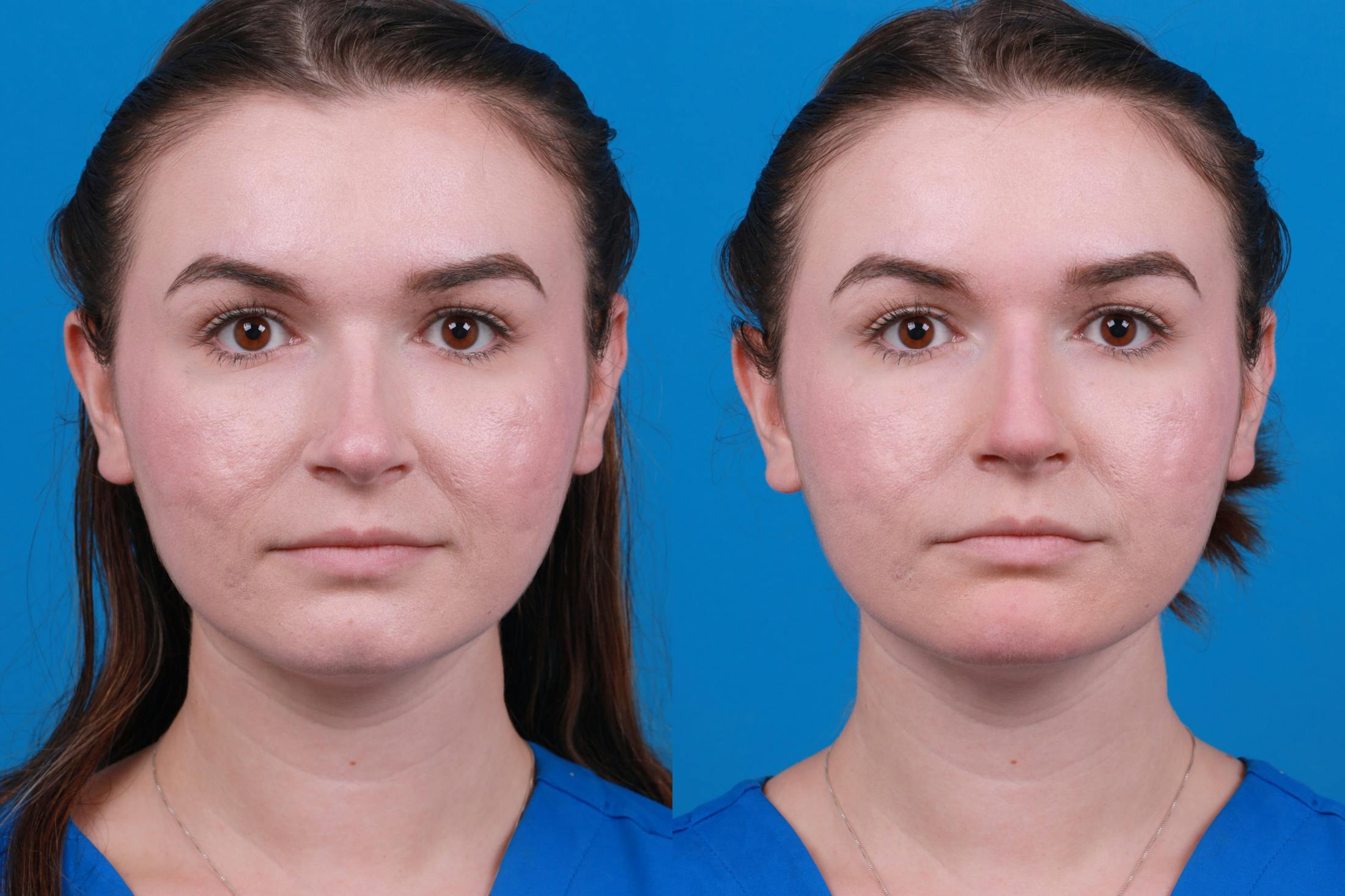 Dermal Fillers Before & After Gallery - Patient 122405853 - Image 3