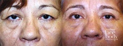 Eyelid Surgery Before & After Gallery - Patient 561447 - Image 1