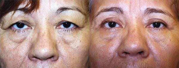Eyelid Surgery Before & After Gallery - Patient 122405848 - Image 1
