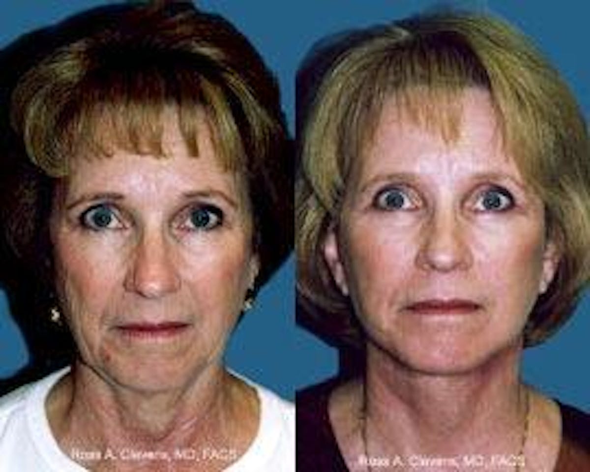Facelift Before & After Gallery - Patient 122405849 - Image 1