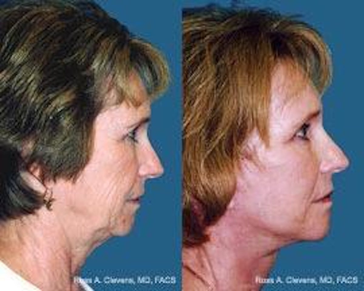 Facelift Before & After Gallery - Patient 122405849 - Image 2