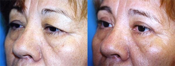Eyelid Surgery Before & After Gallery - Patient 122405848 - Image 2
