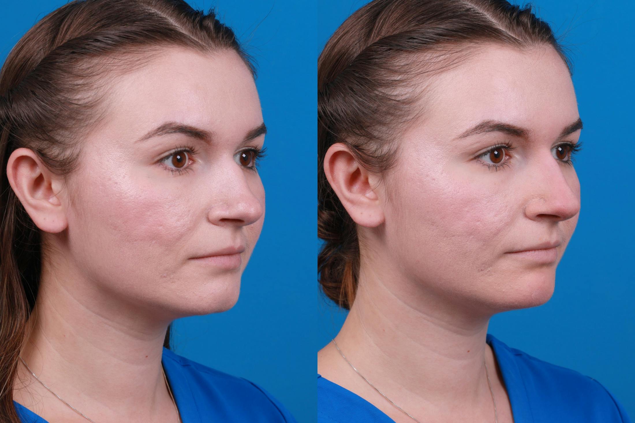 Dermal Fillers Before & After Gallery - Patient 122405853 - Image 4