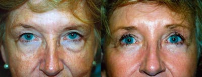 Eyelid Surgery Before & After Gallery - Patient 122405850 - Image 1