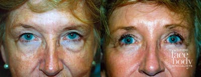 Eyelid Surgery Before & After Gallery - Patient 337862 - Image 1