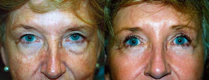 Eyelid Surgery Before & After Gallery - Patient 122405850 - Image 1