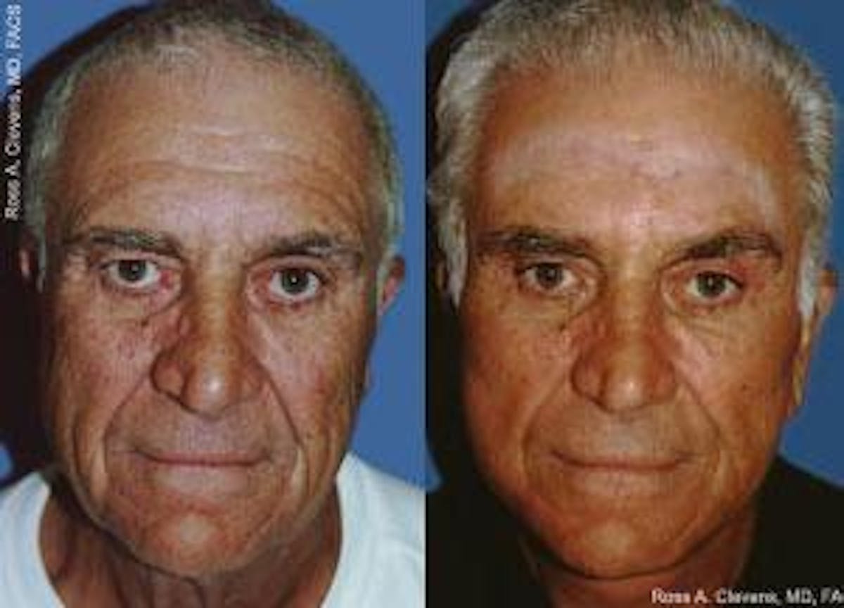 Facelift Before & After Gallery - Patient 122405851 - Image 1
