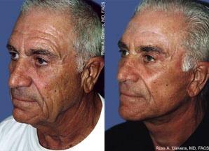 Facelift Before & After Gallery - Patient 122405851 - Image 2