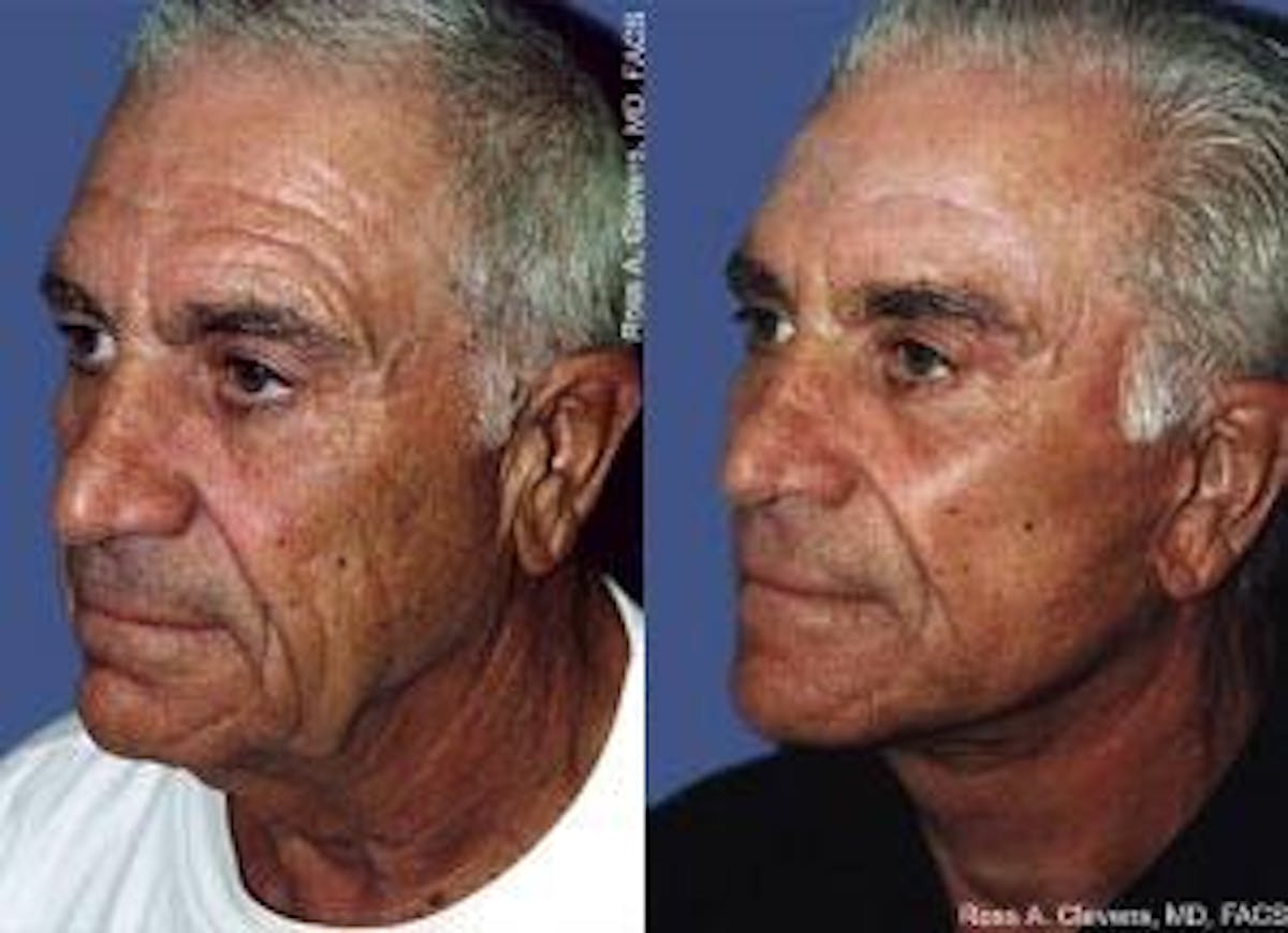 Facelift Before & After Gallery - Patient 122405851 - Image 2