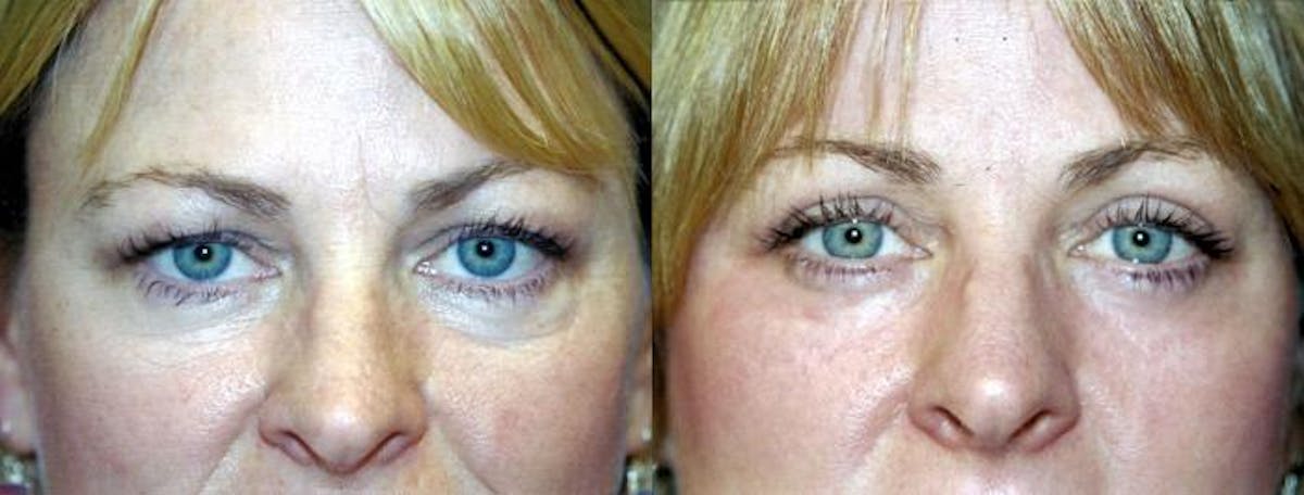 Eyelid Surgery Before & After Gallery - Patient 122405852 - Image 1