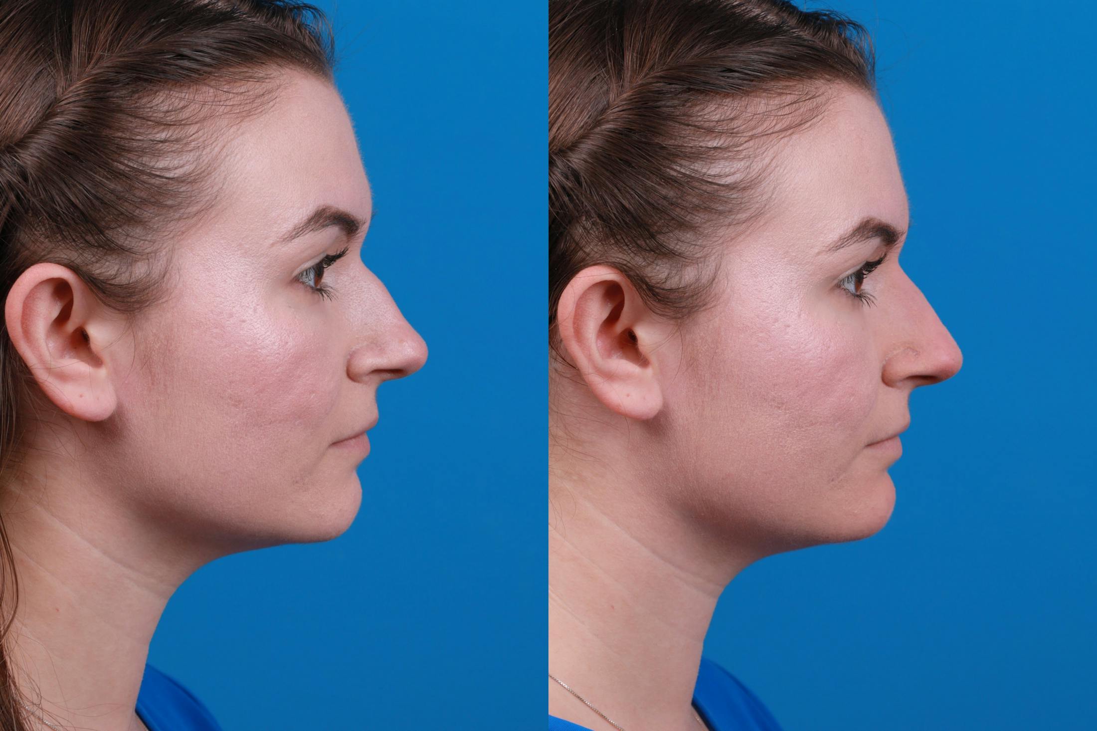 Dermal Fillers Before & After Gallery - Patient 122405853 - Image 5