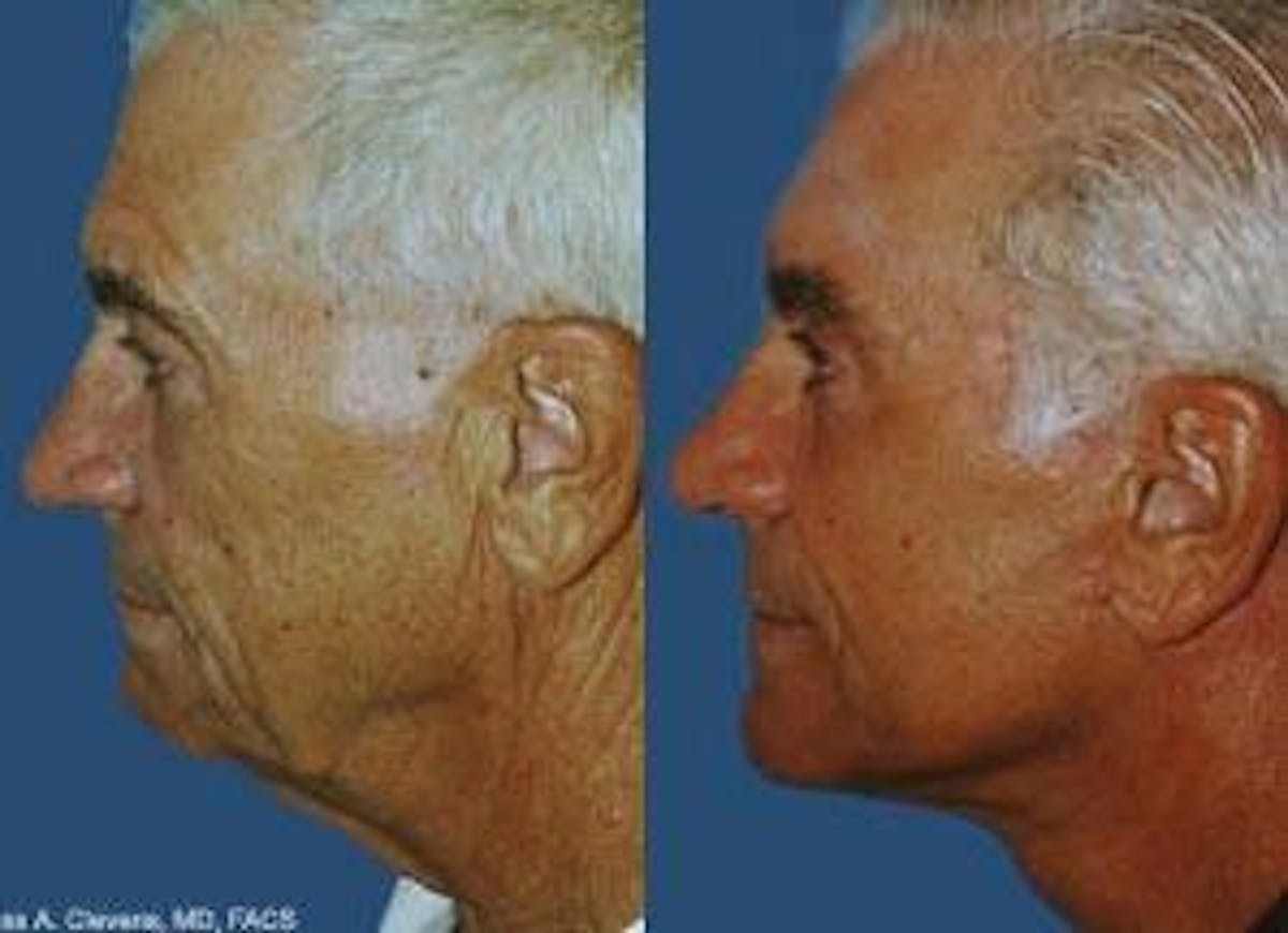 Facelift Before & After Gallery - Patient 122405851 - Image 3
