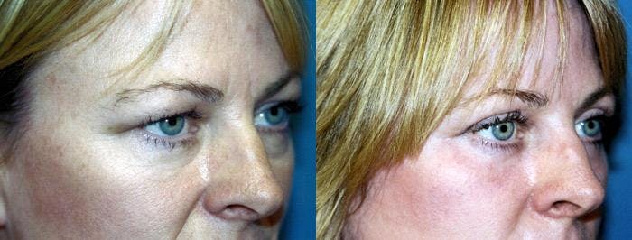 Eyelid Surgery Before & After Gallery - Patient 122405852 - Image 2
