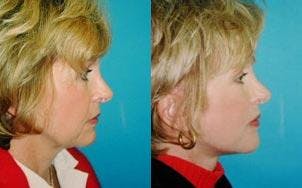 Facelift Before & After Gallery - Patient 122405854 - Image 1