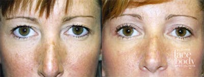 Eyelid Surgery Before & After Gallery - Patient 806487 - Image 1