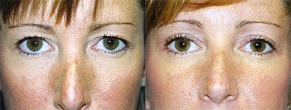 Eyelid Surgery Before & After Gallery - Patient 122405855 - Image 1