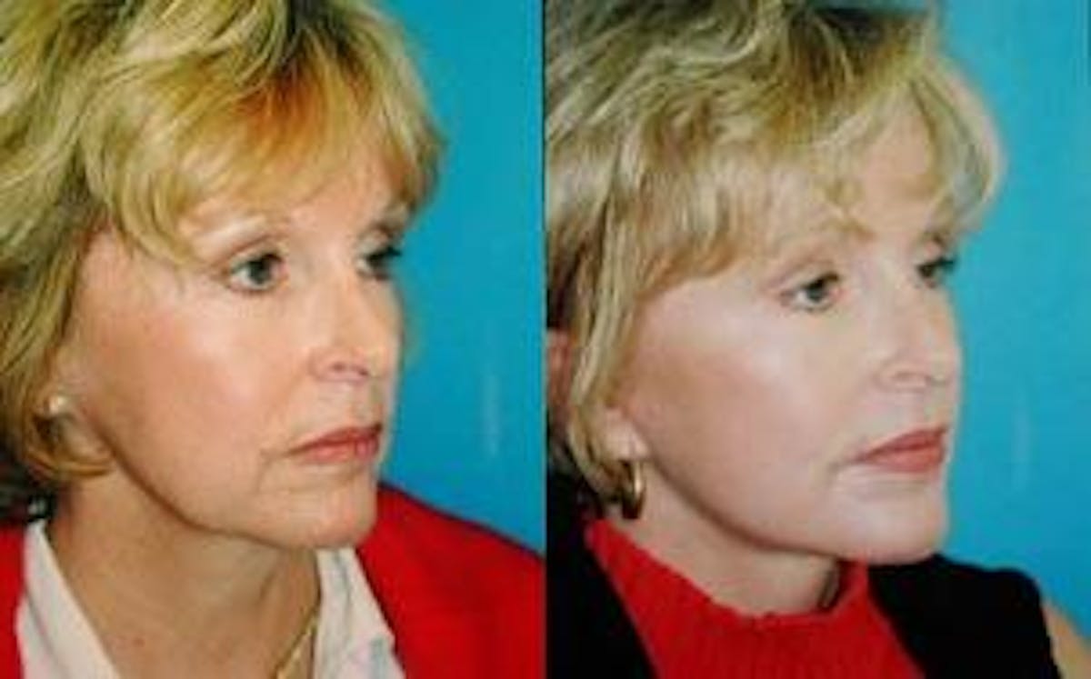 Facelift Before & After Gallery - Patient 122405854 - Image 2
