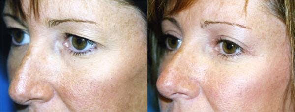 Eyelid Surgery Before & After Gallery - Patient 122405855 - Image 2