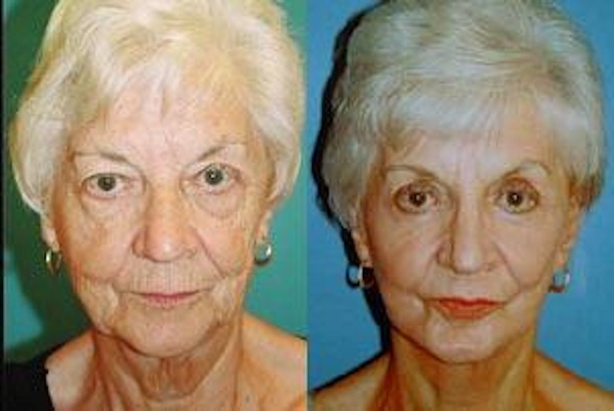 Facelift Before & After Gallery - Patient 122405857 - Image 1