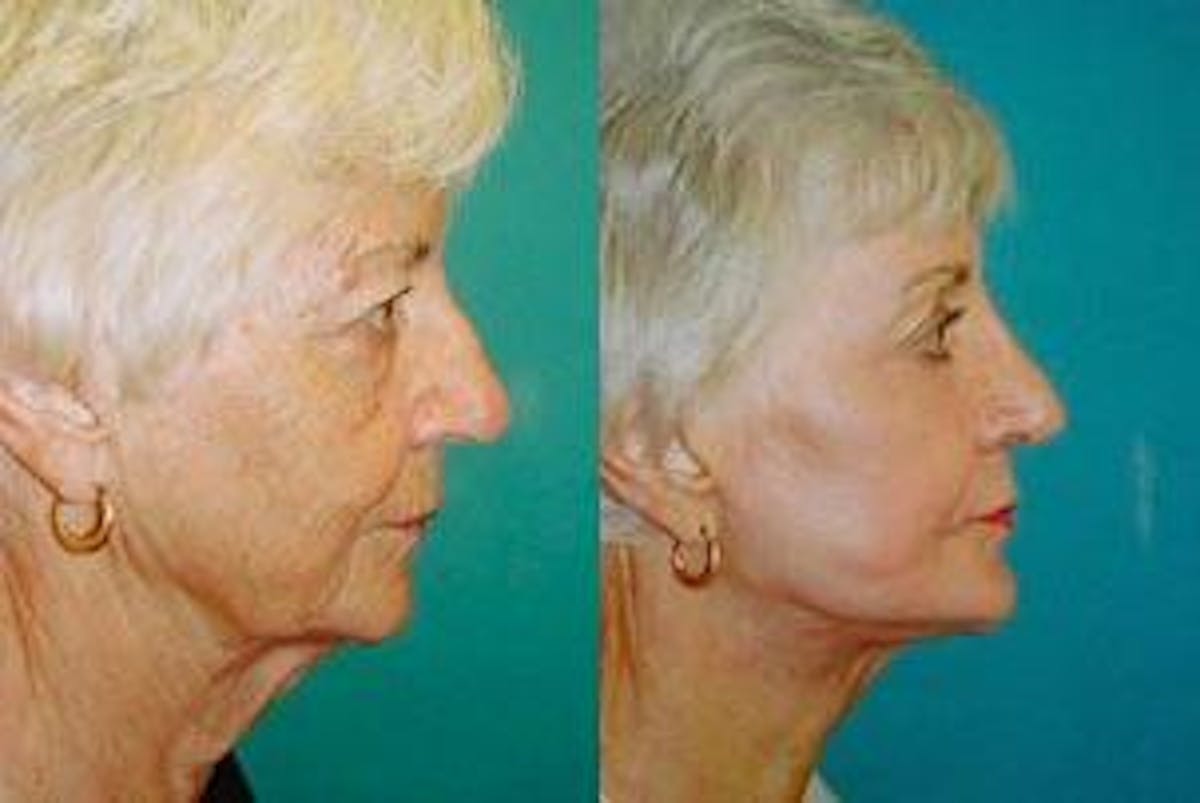 Facelift Before & After Gallery - Patient 122405857 - Image 2