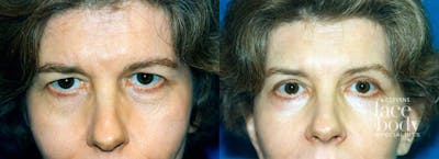Eyelid Surgery Before & After Gallery - Patient 327326 - Image 1