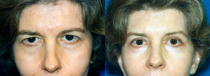 Eyelid Surgery Before & After Gallery - Patient 122405856 - Image 1