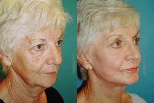 Facelift Before & After Gallery - Patient 122405857 - Image 3