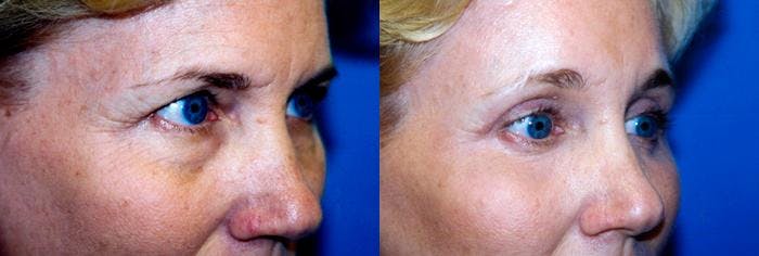 Eyelid Surgery Before & After Gallery - Patient 122405858 - Image 1
