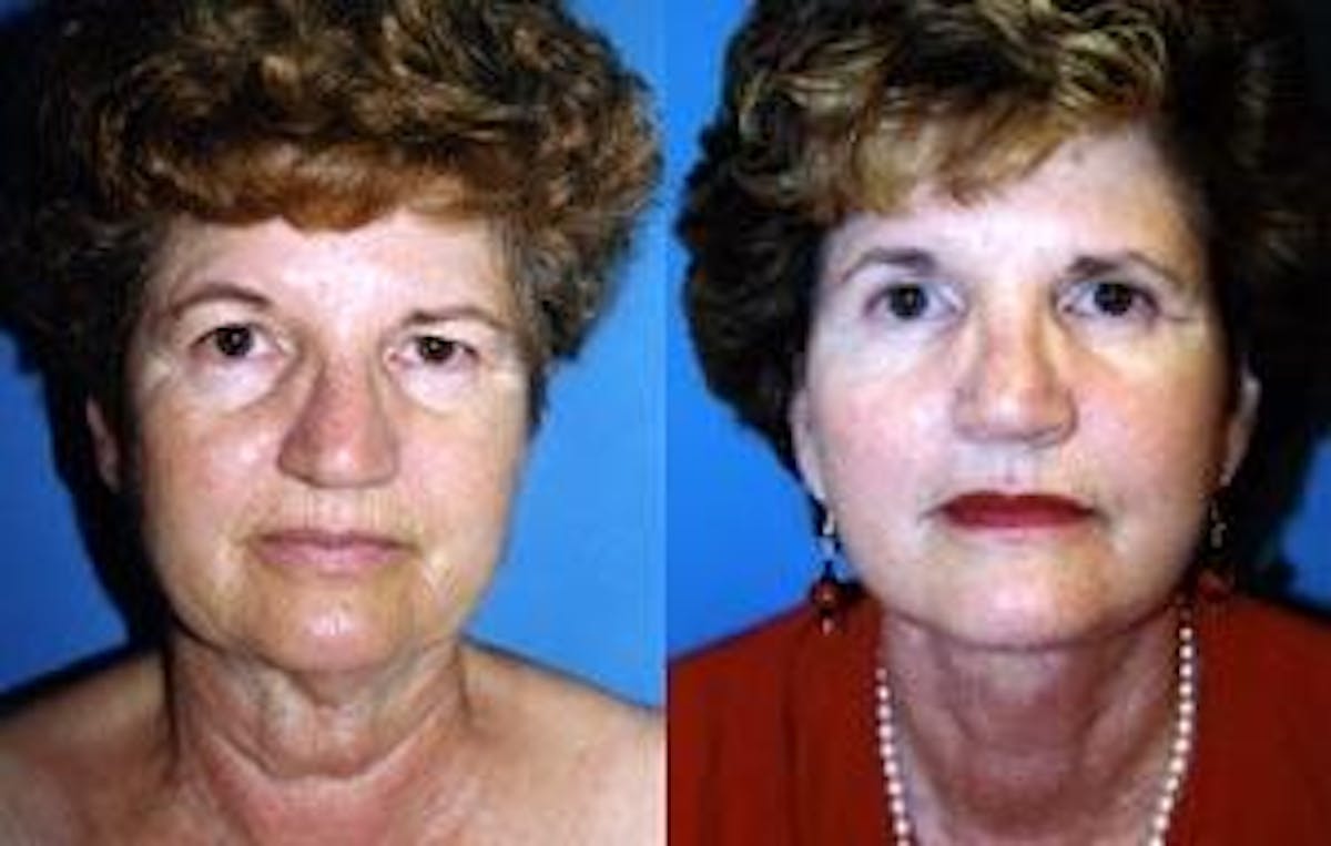 Facelift Before & After Gallery - Patient 122405859 - Image 1