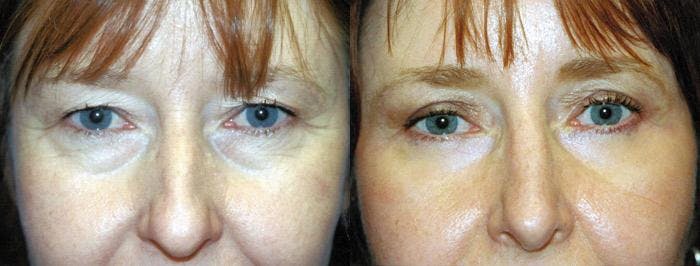 Eyelid Surgery Before & After Gallery - Patient 122405860 - Image 1
