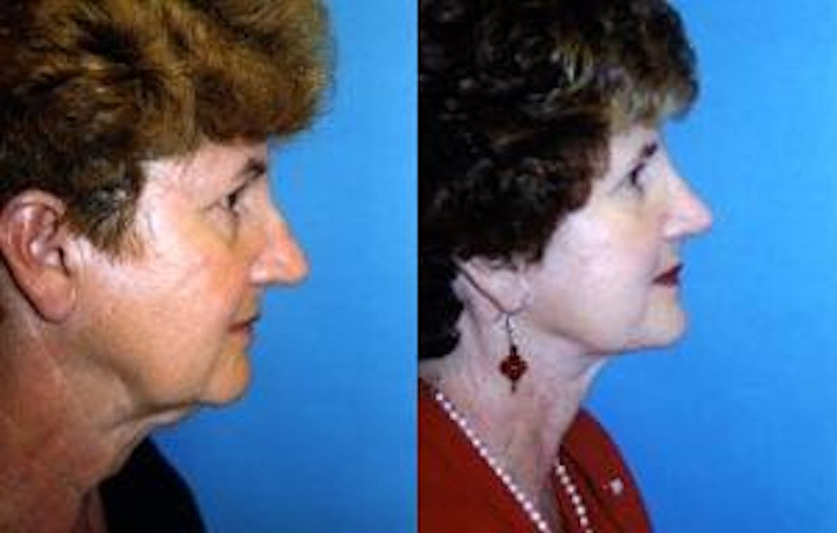 Facelift Before & After Gallery - Patient 122405859 - Image 2
