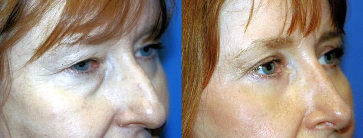 Eyelid Surgery Before & After Gallery - Patient 122405860 - Image 2