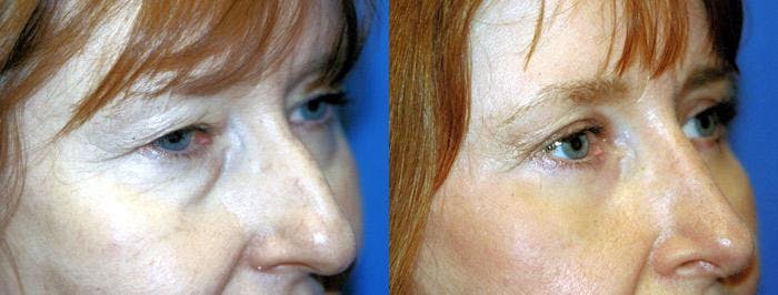 Eyelid Surgery Before & After Gallery - Patient 122405860 - Image 2