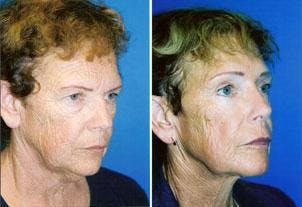 Facelift Before & After Gallery - Patient 122405861 - Image 1